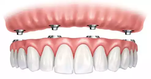 مقایسه ایمپلنت و دندان مصنوعی متحرک: سرمایه گذاری روی کدام یک بهتر است؟