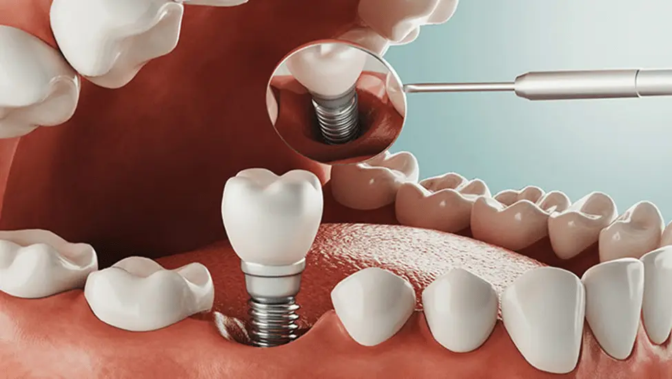 همه چیز در خصوص جراح ایمپلنت دندان